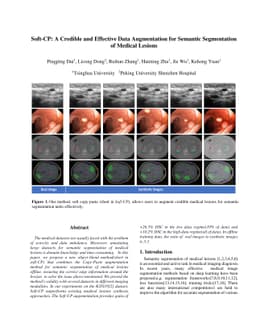 Soft-CP: A Credible and Effective Data Augmentation for Semantic
  Segmentation of Medical Lesions