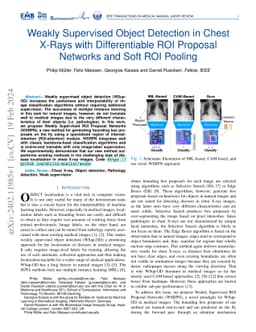 Weakly Supervised Object Detection in Chest X-Rays with Differentiable
  ROI Proposal Networks and Soft ROI Pooling